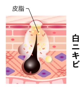 白ニキビ