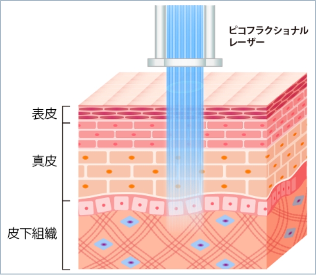 ピコフラクショナル