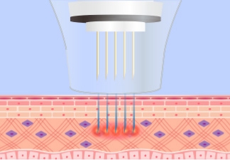 針でできた穴に薬剤が入り真皮層まで届く