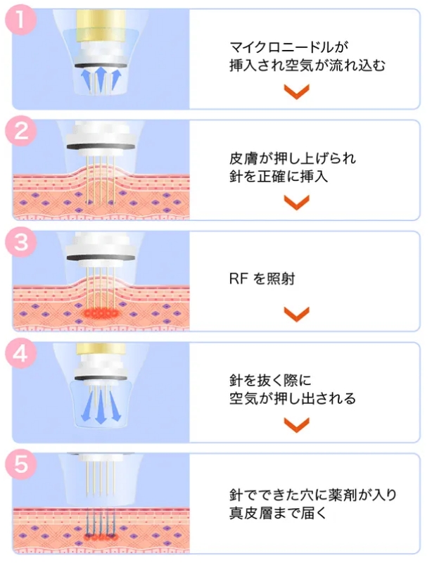 ドラックデリバリーシステムで薬剤がしっかり浸透
