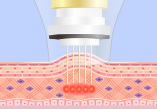RF（高周波）を照射