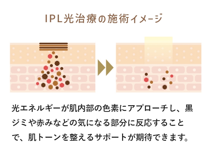 IPL光治療の施術イメージ