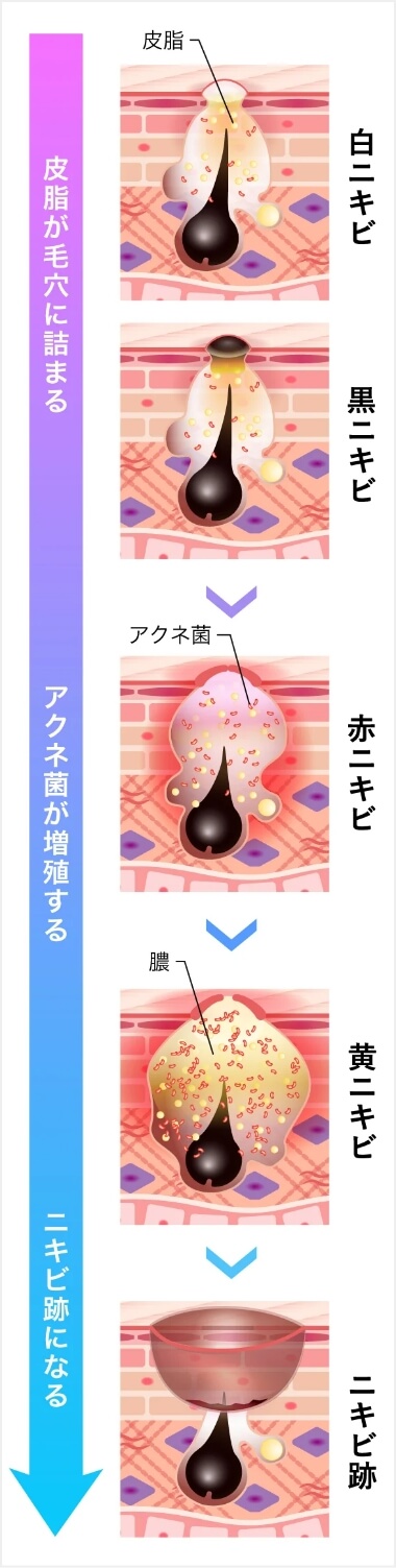 ニキビの種類について