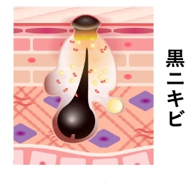 黒ニキビ