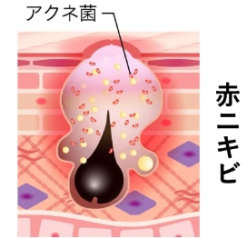 赤ニキビ