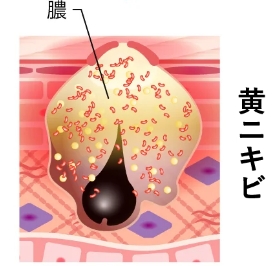 黄ニキビ