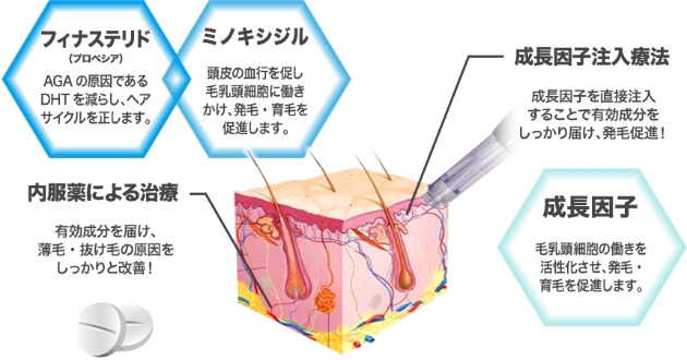 AGAメソセラピーの方法