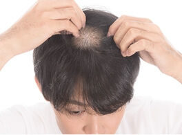 頭頂部の髪の毛が薄くなった
