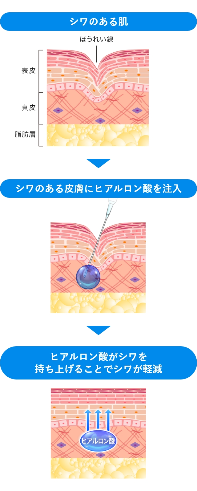 おでこのシワのヒアルロン酸注射とは