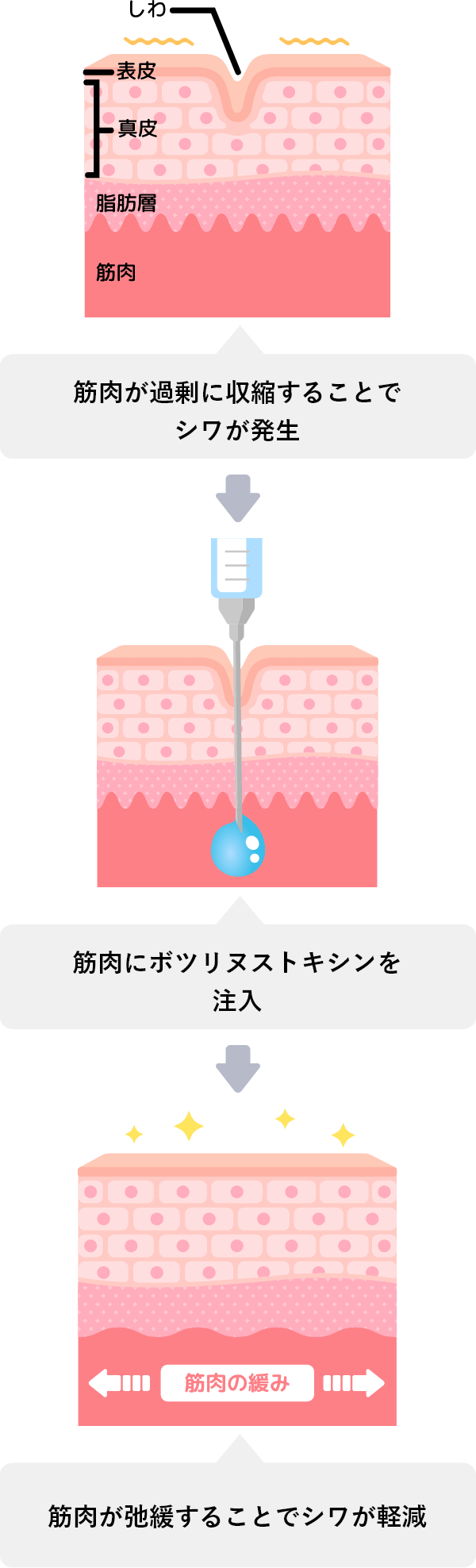 おでこのシワのボトックス注射とは