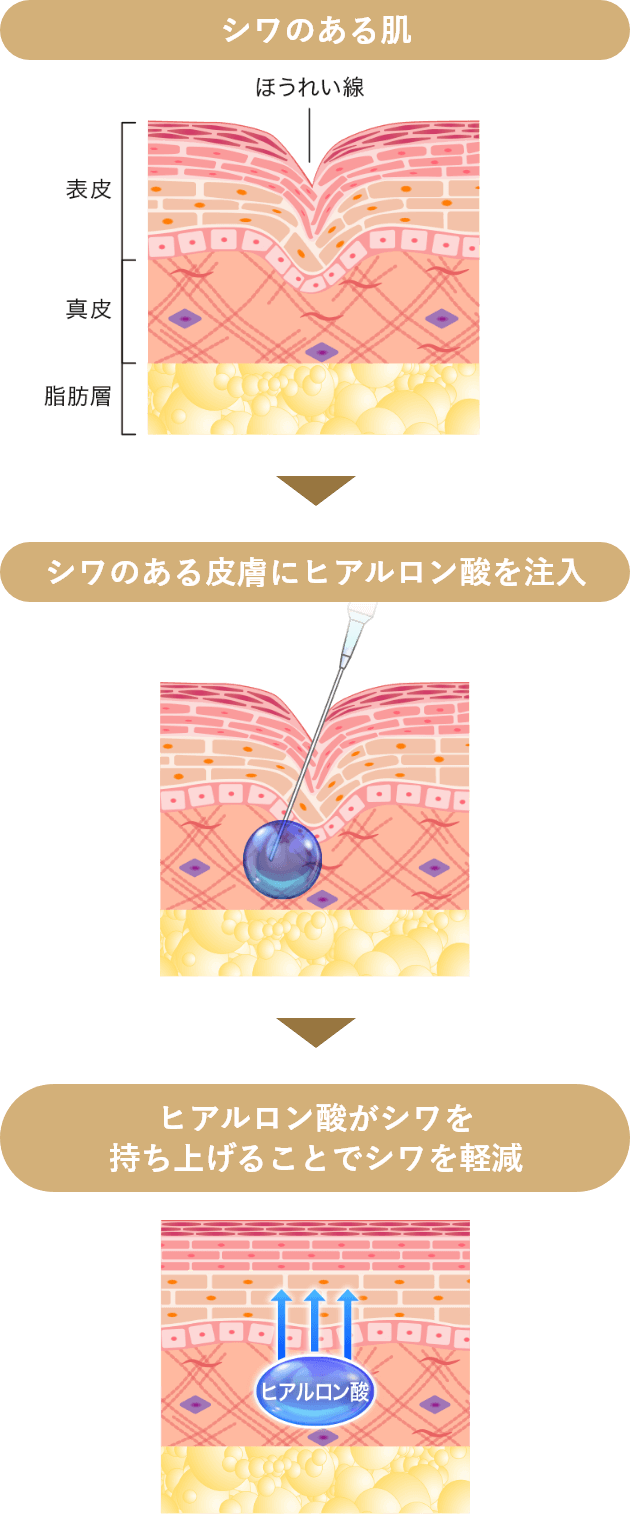 ほうれい線のヒアルロン酸注射とは