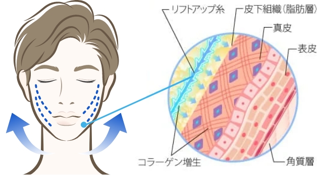 TCB小顔リフト（糸リフト）とは