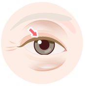 目の上のたるみ眼瞼下垂