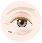 目の下のたるみクマ