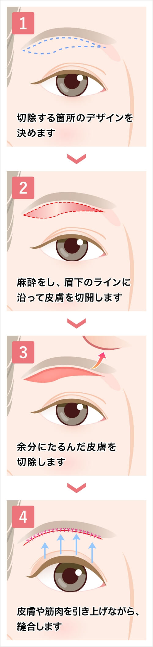 眉下切開（眉下リフト）とは