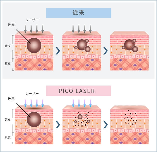 ピコトーニング