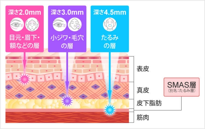 TCBではソノクイーンを使用
