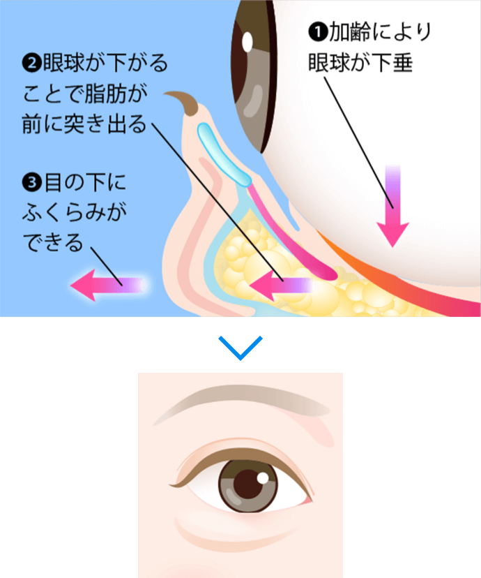 目の下のたるみのメカニズム