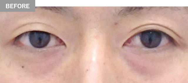 BEFORE