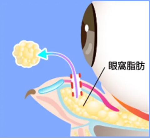 経結膜脱脂法