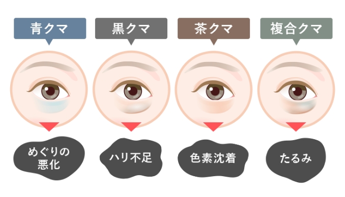 青クマ:めぐりの悪化、黒クマ:ハリ不足、茶クマ:色素沈着、複合クマ:たるみ