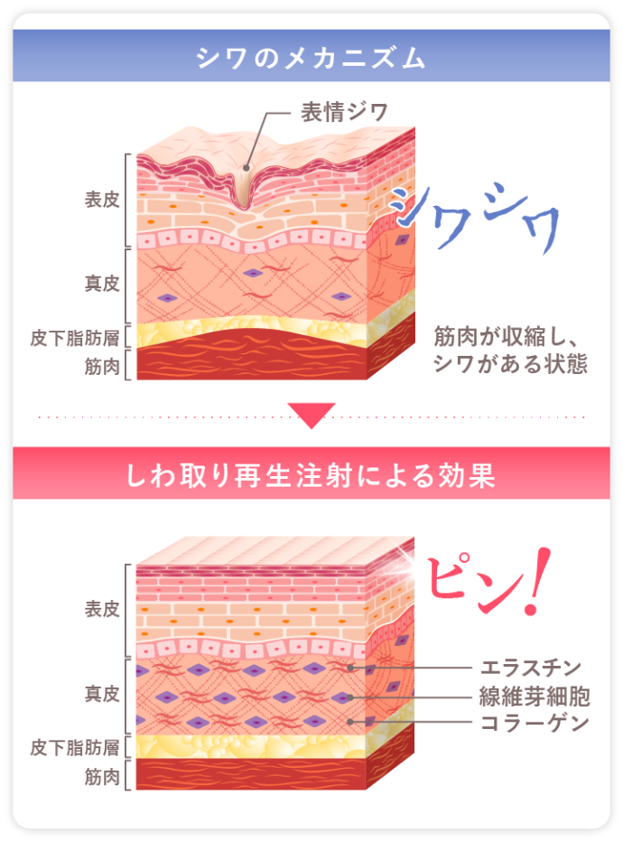 シワのメカニズム/しわ取り再生注射による効果