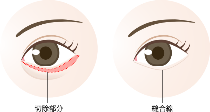 切開法による目の下のたるみ取り(下眼瞼除皺術)とは?