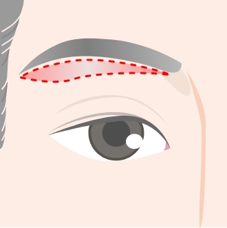 2. 麻酔をし、眉下のラインに沿って皮膚を切開します