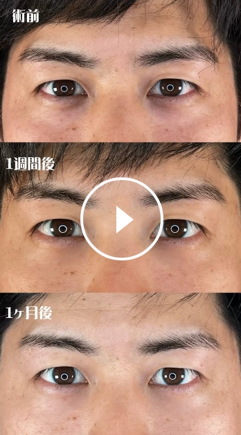 切らない目の下のクマ・たるみ取り
