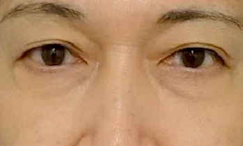黒クマ after