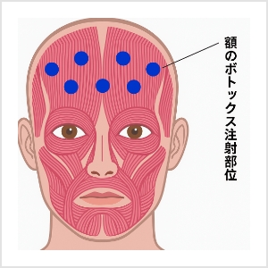 シワ改善ボトックス注射とは？
