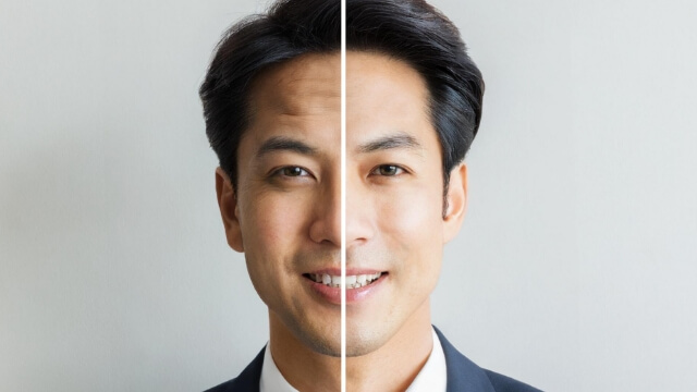 シワ改善ボトックス注射とは？