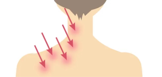 肩こりボトックス注射とは？
