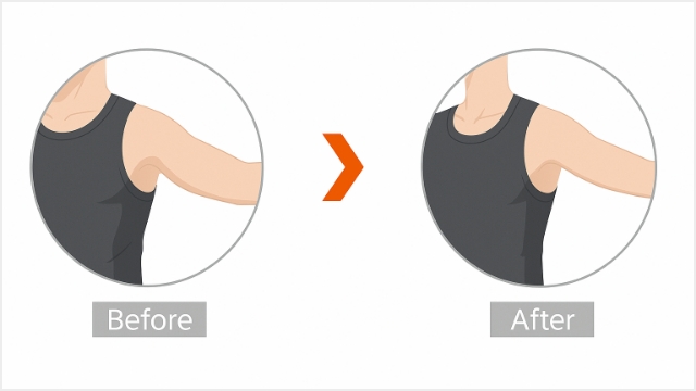 腕・脚痩せ改善ボトックス注射とは？