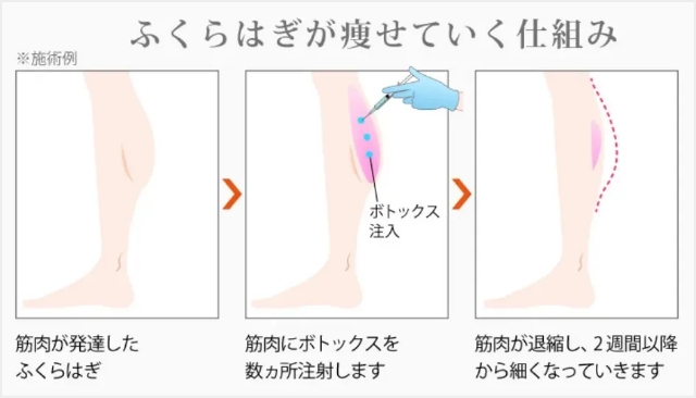 腕・脚痩せ改善ボトックス注射とは？