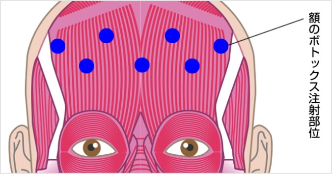 ボトックス注射の額の注射部位