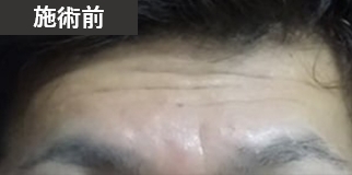 施術前