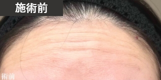 施術前