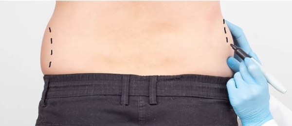 腹部の脂肪吸引