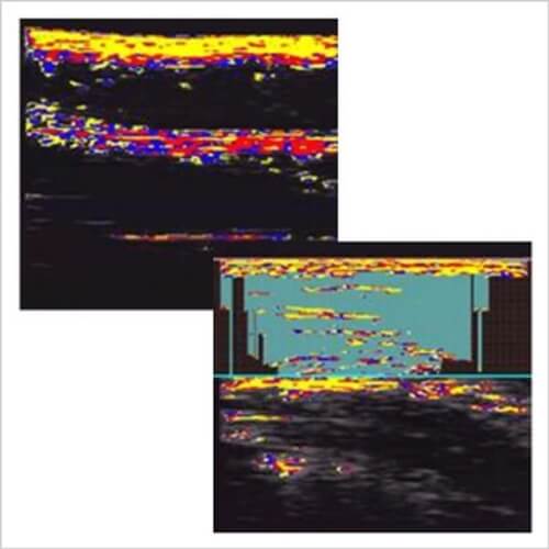 セルライト皮下脂肪の質・タイプ分析