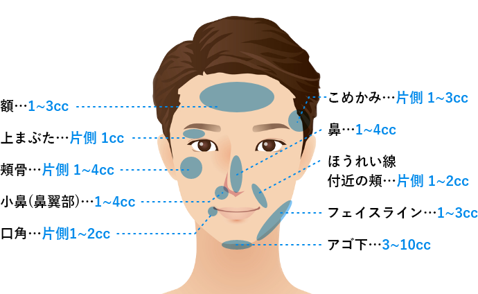 BNLSルティメット（脂肪溶解注射）の施術部位一覧