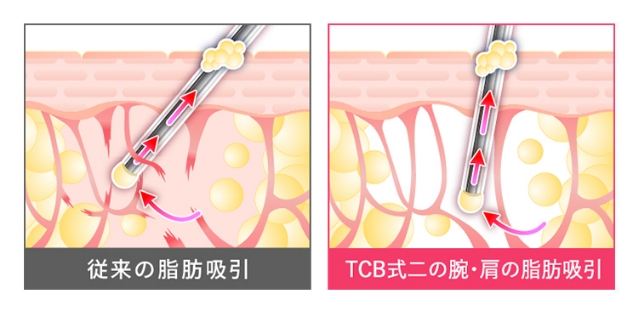 二の腕・肩の脂肪吸引