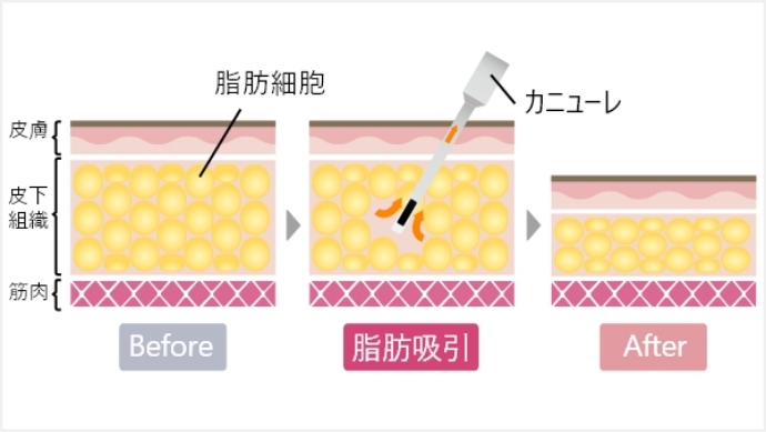 1度の施術で効果はあるのか？