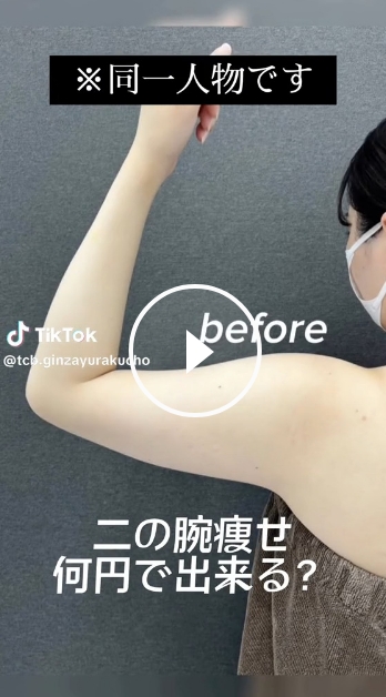 理想の二の腕・肩を叶えるTCB式脂肪吸引