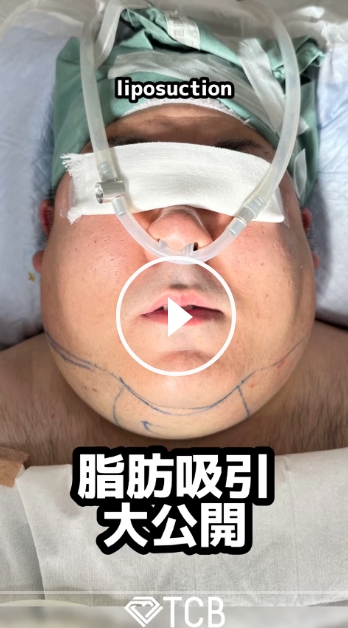 理想のフェイスラインを目指す顔の脂肪吸引