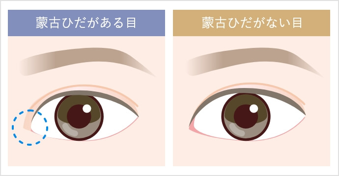 挙筋前転法(クイックデカ目術)