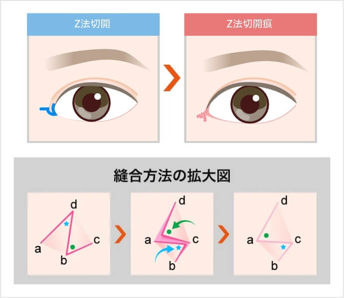 Z法
