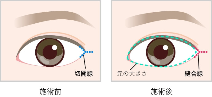 V-Yflapを応用した術式