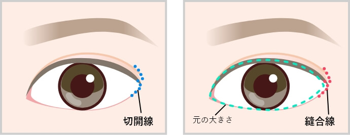 W形成術を応用した術式