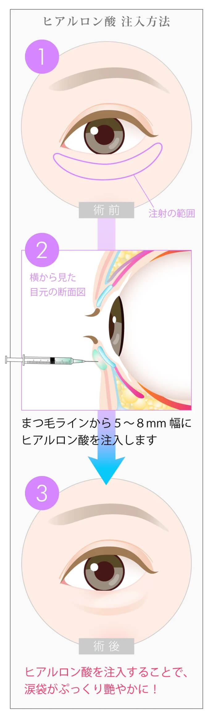 涙袋の形成方法